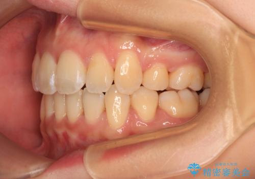 閉じにくい口元を抜歯矯正ですっきりとの治療後