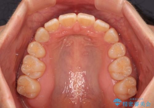閉じにくい口元を抜歯矯正ですっきりとの治療後