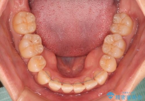 閉じにくい口元を抜歯矯正ですっきりとの治療後