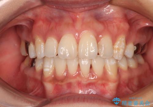 ワイヤー装置の抜歯矯正で横顔の口元の印象をすっきりとの症例 治療後