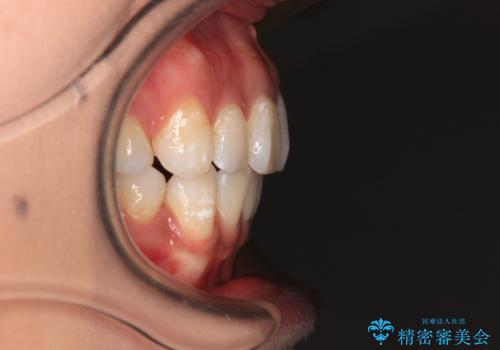 ワイヤー装置の抜歯矯正で横顔の口元の印象をすっきりとの治療後