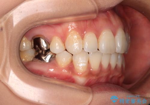 ワイヤー装置の抜歯矯正で横顔の口元の印象をすっきりとの治療後