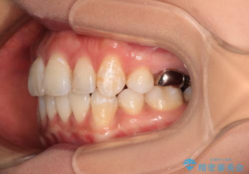 ワイヤー装置の抜歯矯正で横顔の口元の印象をすっきりとの治療後