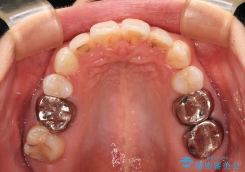 ワイヤー装置の抜歯矯正で横顔の口元の印象をすっきりとの治療後