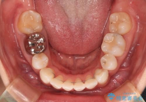 ワイヤー装置の抜歯矯正で横顔の口元の印象をすっきりとの治療後