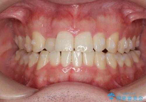 前歯が隠れていて見えない クロスバイトの矯正治療の治療中