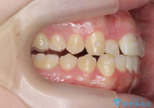 前歯が隠れていて見えない クロスバイトの矯正治療の治療中