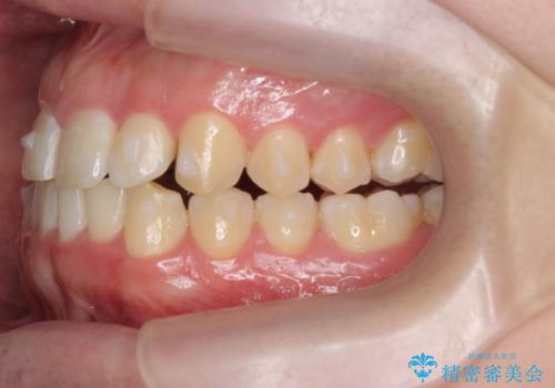 前歯が隠れていて見えない クロスバイトの矯正治療の治療中