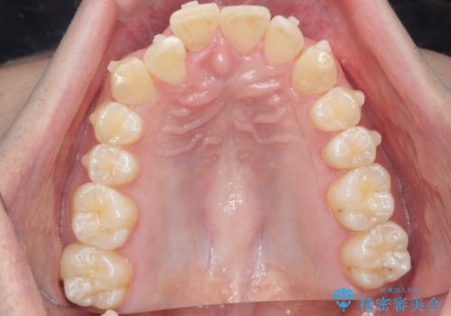 前歯が隠れていて見えない クロスバイトの矯正治療の治療中
