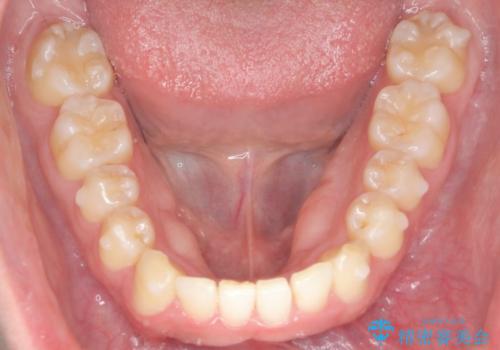 前歯が隠れていて見えない クロスバイトの矯正治療の治療中