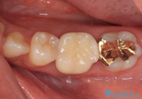 仮詰めのまま処置が進まないので転院　奥歯のむし歯治療の症例 治療後