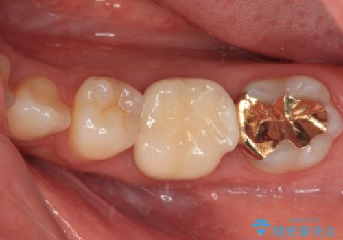 仮詰めのまま処置が進まないので転院 奥歯のむし歯治療