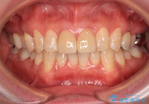 つぎはぎとグレーに透ける色が気になる 前歯のオールセラミッククラウン治療の治療後