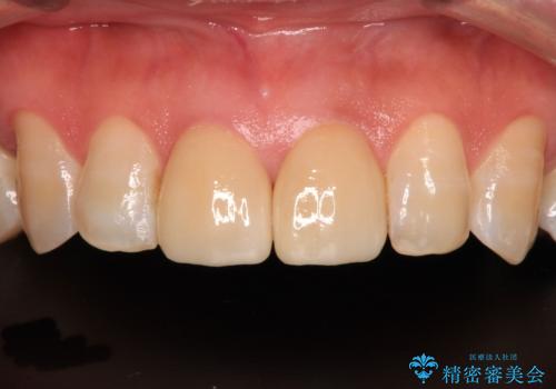 つぎはぎとグレーに透ける色が気になる 前歯のオールセラミッククラウン治療の治療後