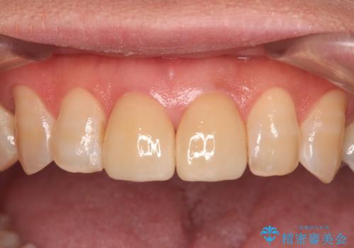 つぎはぎとグレーに透ける色が気になる 前歯のオールセラミッククラウン治療の治療後