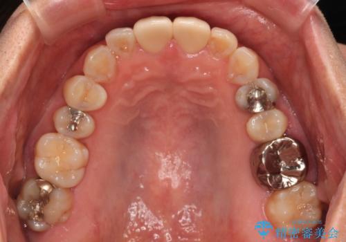 つぎはぎとグレーに透ける色が気になる 前歯のオールセラミッククラウン治療の治療後