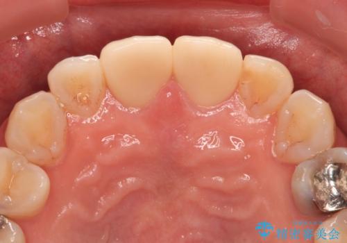 つぎはぎとグレーに透ける色が気になる 前歯のオールセラミッククラウン治療の治療後