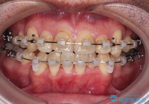 デコボコを治したい 八重歯の抜歯矯正の治療中