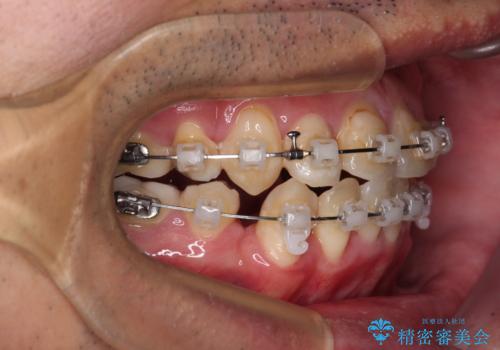 デコボコを治したい 八重歯の抜歯矯正の治療中