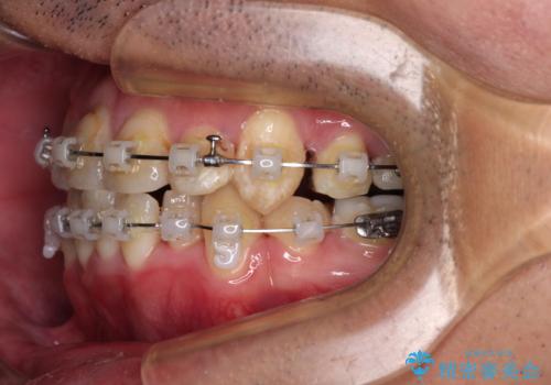 デコボコを治したい　八重歯の抜歯矯正の治療中
