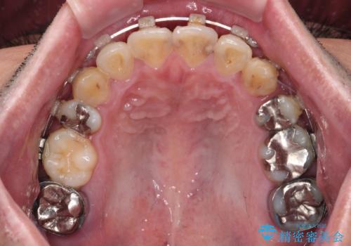 デコボコを治したい 八重歯の抜歯矯正の治療中