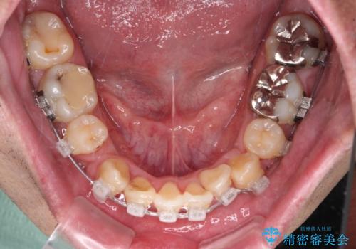 デコボコを治したい 八重歯の抜歯矯正の治療中