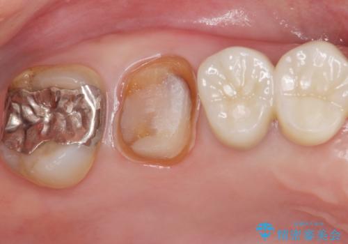 歯が欠けて染みるの治療中