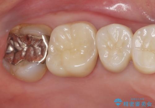 歯が欠けて染みるの症例 治療後