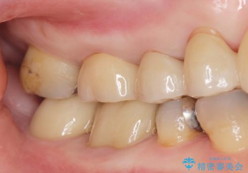 歯が欠けて染みるの治療後