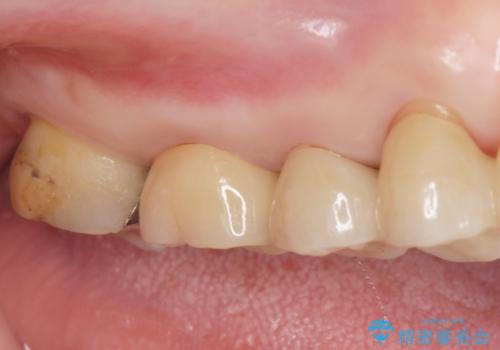 歯が欠けて染みるの治療後