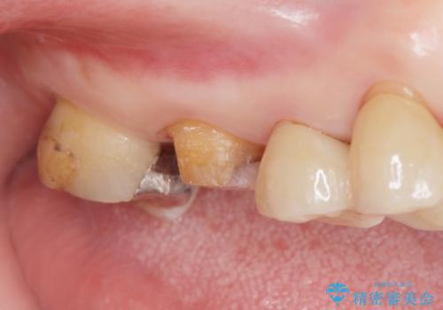 歯が欠けて染みるの治療中