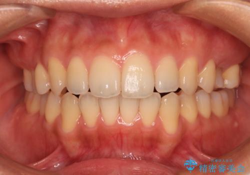 残存乳歯とオープンバイト　インビザラインによる矯正治療の治療後