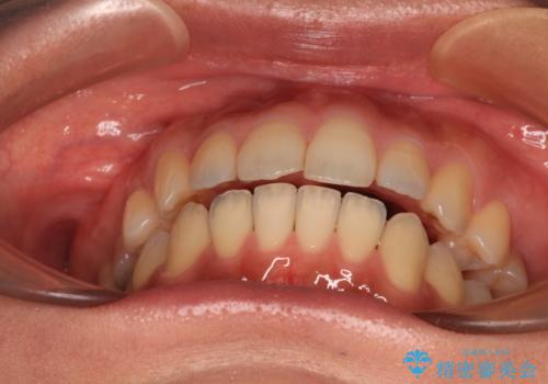 残存乳歯とオープンバイト インビザラインによる矯正治療の治療後