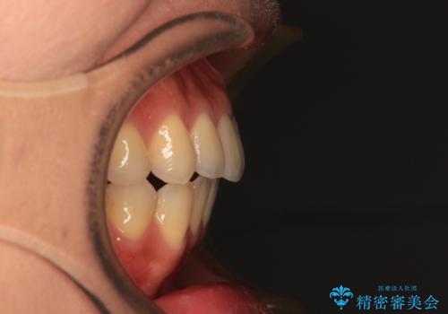 残存乳歯とオープンバイト インビザラインによる矯正治療の治療後