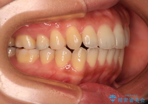 残存乳歯とオープンバイト　インビザラインによる矯正治療の治療後
