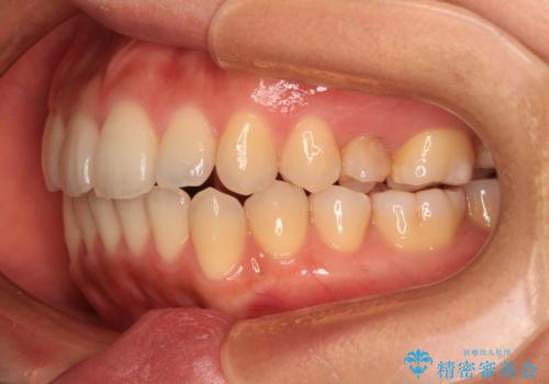 残存乳歯とオープンバイト インビザラインによる矯正治療の治療後
