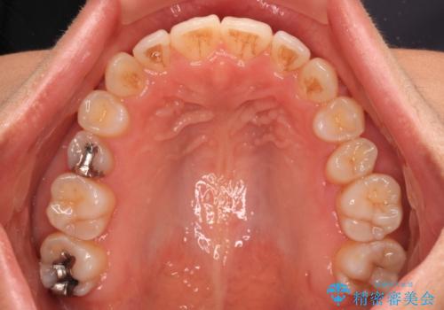 残存乳歯とオープンバイト インビザラインによる矯正治療の治療後