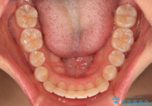 残存乳歯とオープンバイト インビザラインによる矯正治療の治療後