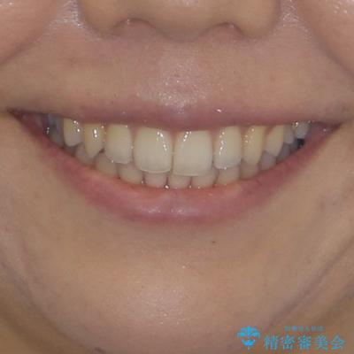 残存乳歯とオープンバイト インビザラインによる矯正治療の治療後(顔貌)