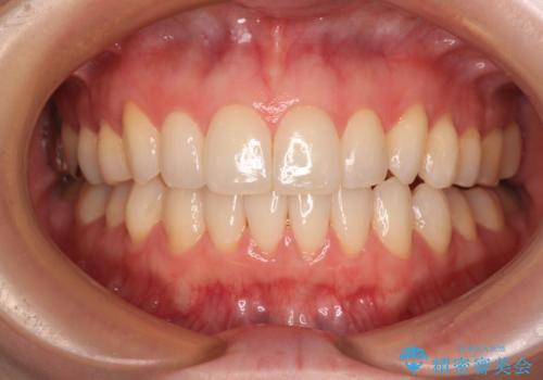 前歯のデコボコをインビザラインで改善の症例 治療後