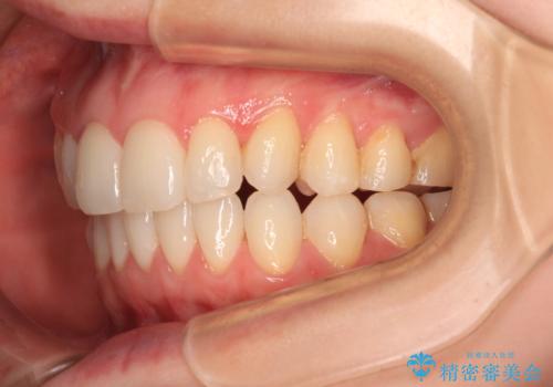 前歯のデコボコをインビザラインで改善の治療後