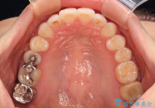 前歯のデコボコをインビザラインで改善の治療後