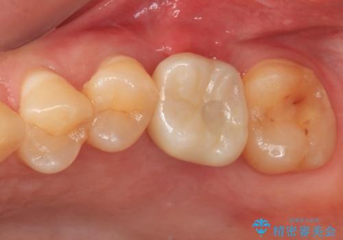 割れてしまった奥歯 サイナスリフトによるインプラント補綴治療の症例 治療後