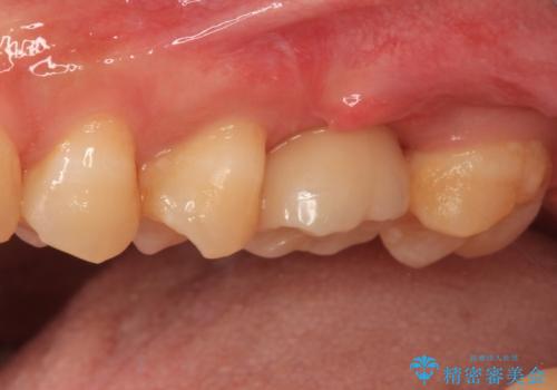 割れてしまった奥歯 サイナスリフトによるインプラント補綴治療の治療後