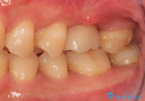 割れてしまった奥歯 サイナスリフトによるインプラント補綴治療の治療後