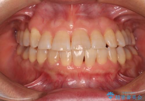 骨格のずれをカムフラージュ クロスバイトのワイヤー矯正の症例 治療後