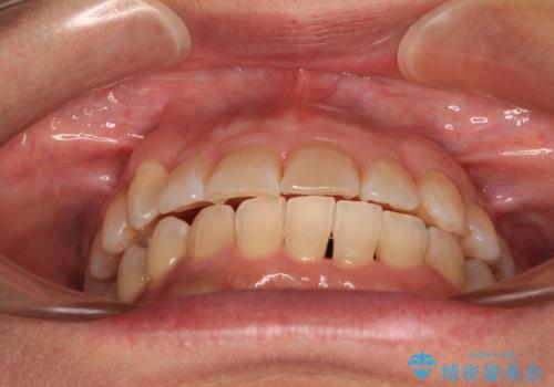 骨格のずれをカムフラージュ クロスバイトのワイヤー矯正の治療後