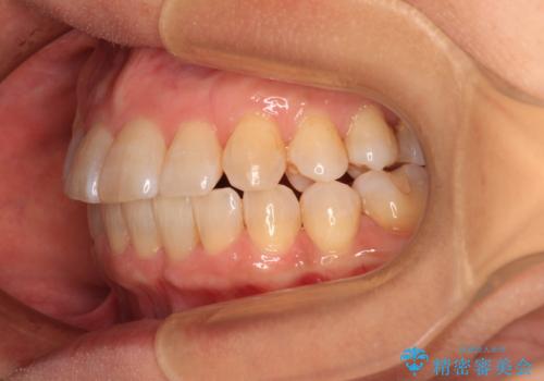 骨格のずれをカムフラージュ クロスバイトのワイヤー矯正の治療後