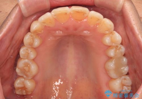 骨格のずれをカムフラージュ クロスバイトのワイヤー矯正の治療後