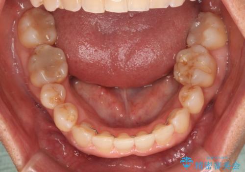 骨格のずれをカムフラージュ クロスバイトのワイヤー矯正の治療後